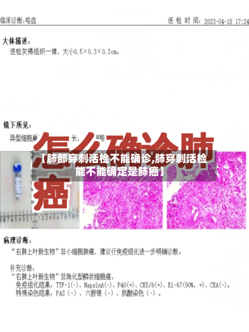 【肺部穿刺活检不能确诊,肺穿刺活检能不能确定是肺癌】-第2张图片