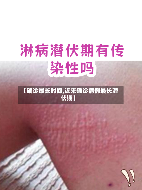 【确诊最长时间,近来确诊病例最长潜伏期】-第3张图片