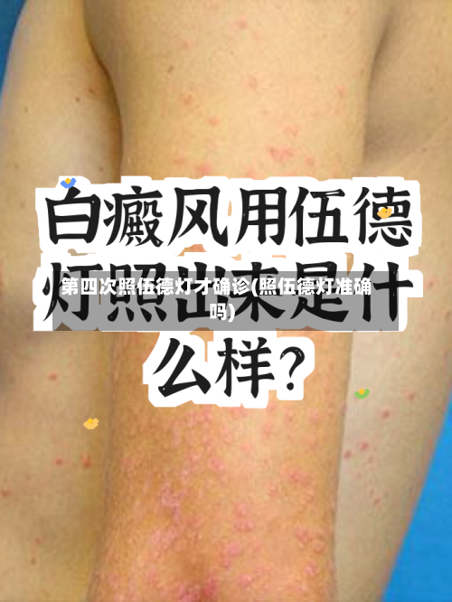 第四次照伍德灯才确诊(照伍德灯准确吗)