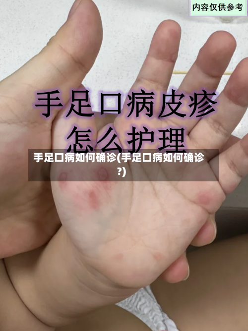 手足口病如何确诊(手足口病如何确诊?)-第2张图片