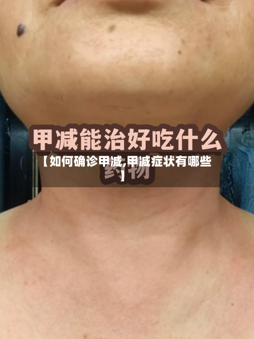 【如何确诊甲减,甲减症状有哪些】-第2张图片